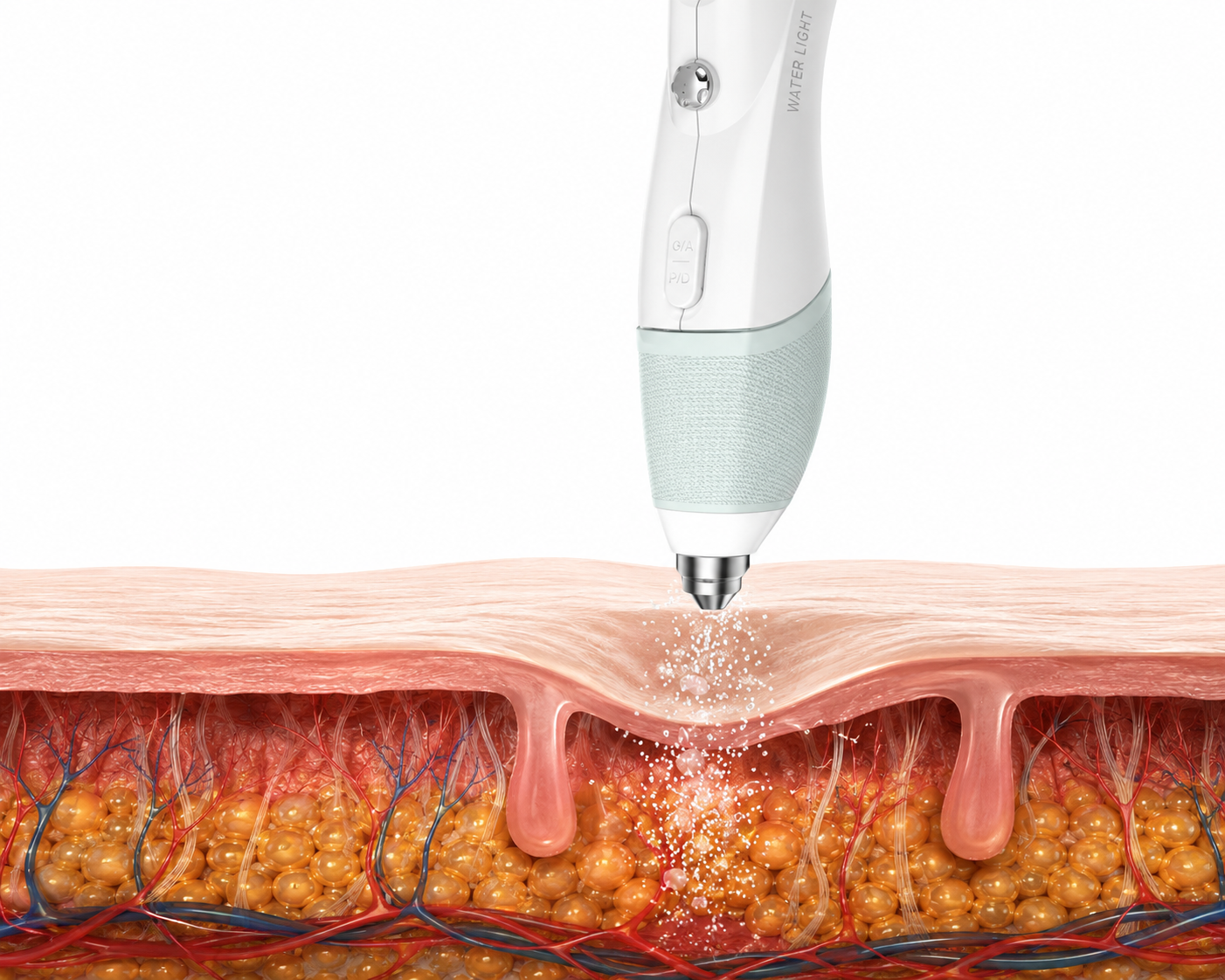 Infuzja tlenowa / Mezoterapia wodna